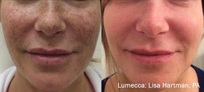 LH_2a_1tx_Freckles