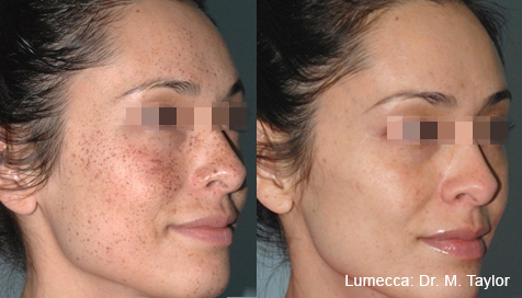 MT_Lumecca_1c_580nm_ShortPulse_StrongCooling_DermaPop_2Intersectingpasses_17J